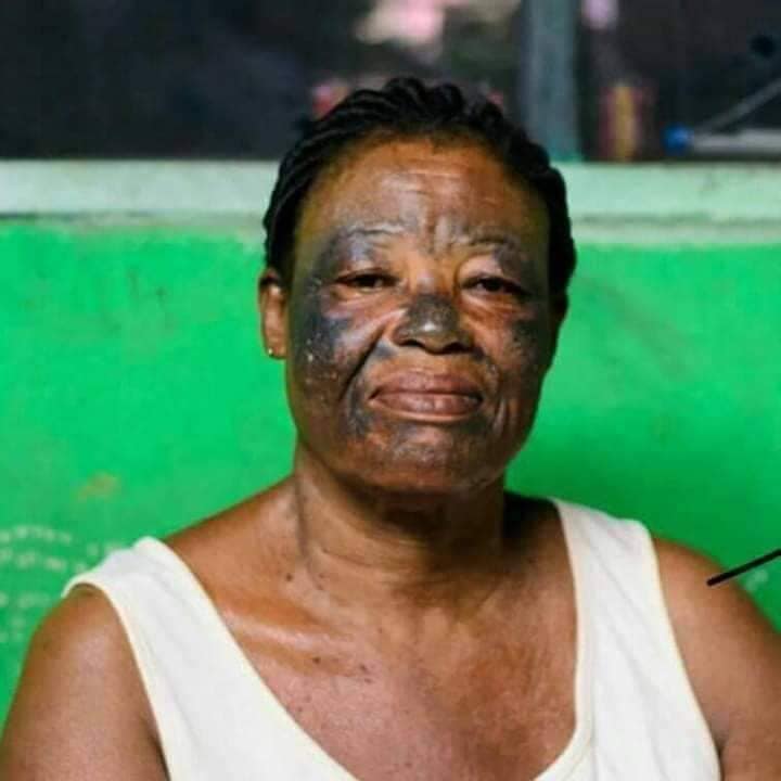 MÉLASMA : COMPRENDRE CETTE HYPERPIGMENTATION ET COMMENT EN PRENDRE SOIN