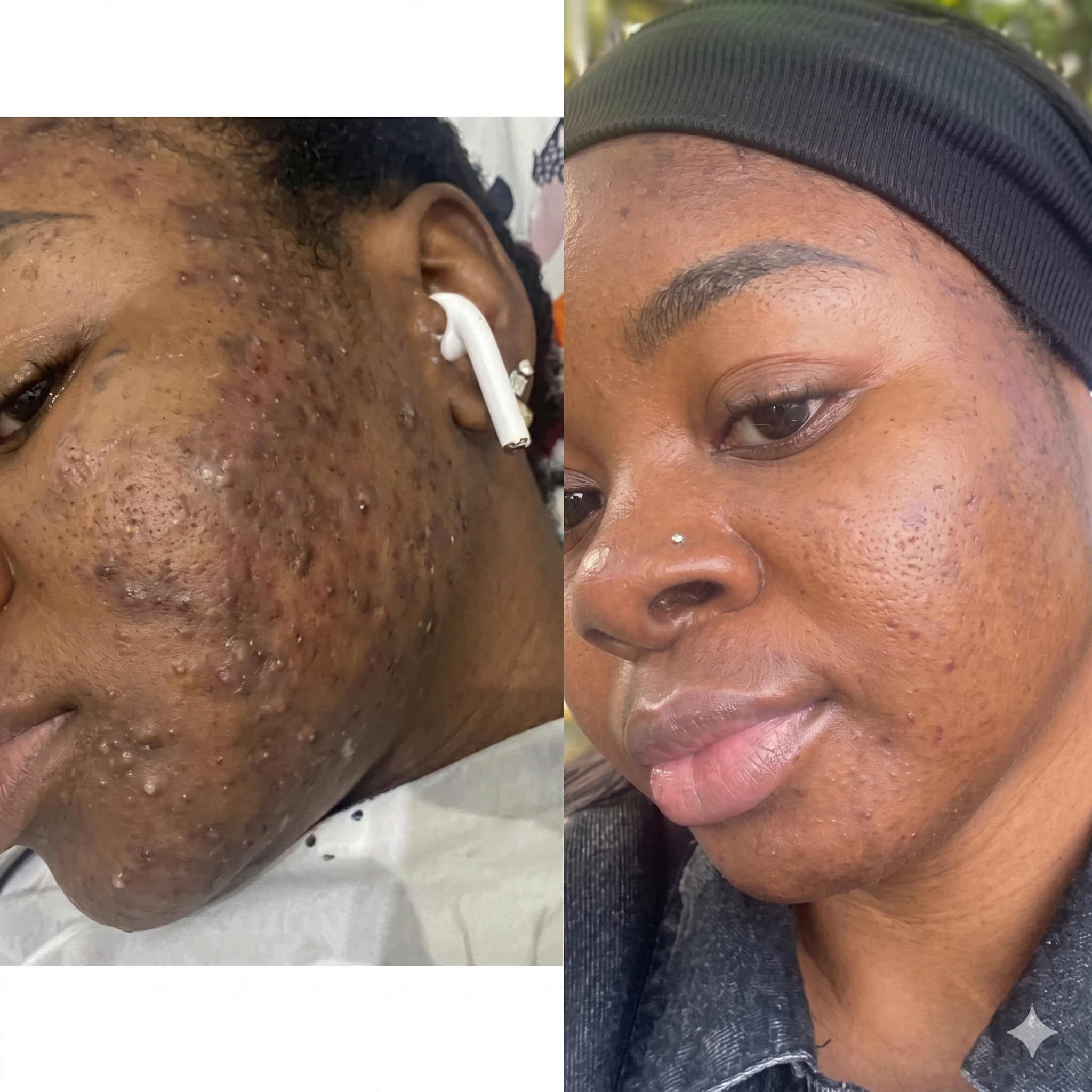 BOUTONS ET IMPERFECTIONS : COMPRENDRE LEURS CAUSES ET COMMENT EN PRENDRE SOIN
